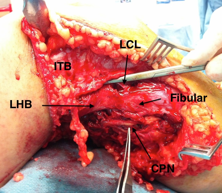 Lateral Approach 2